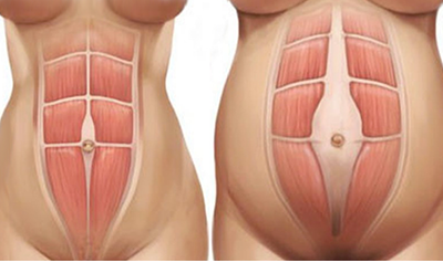 Diastasi Addominale