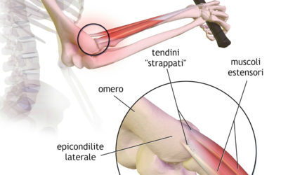 Epicondilite: come curarla velocemente con fisioterapia balduina